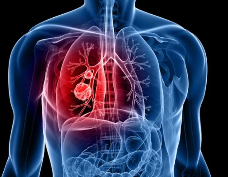 Neue Behandlungen für Lungenkrebs