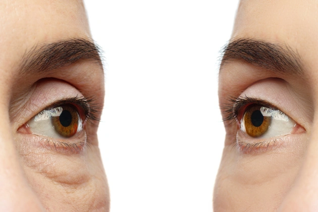 Erschlaffte Augenlider können behandelt werden